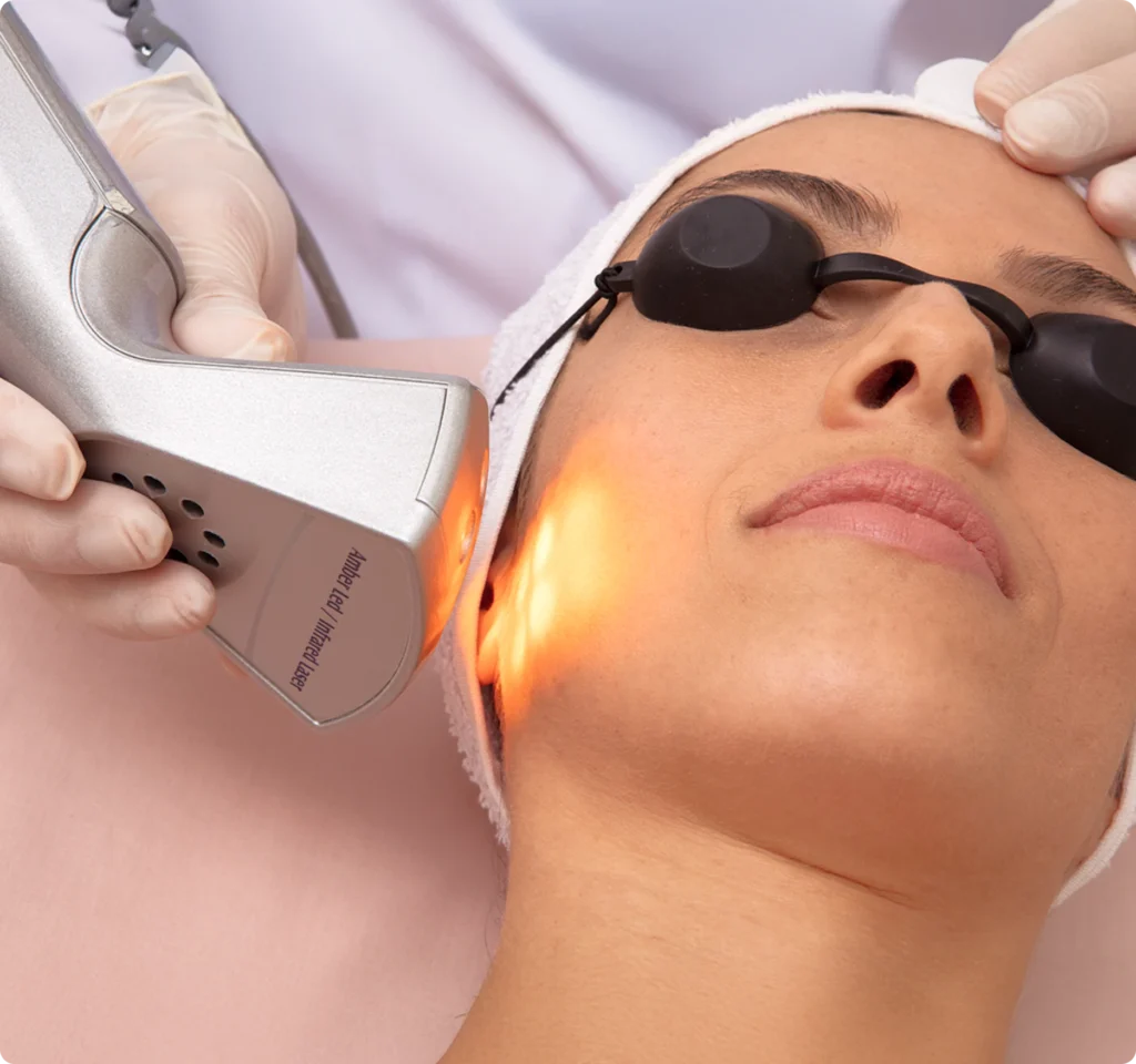 Laser para clareamento de mancha e melasma em Campinas