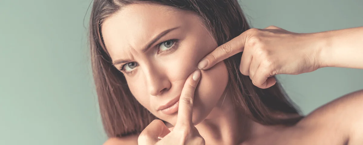 Tratamentos faciais para acne da mulher adulta em Campinas-SP