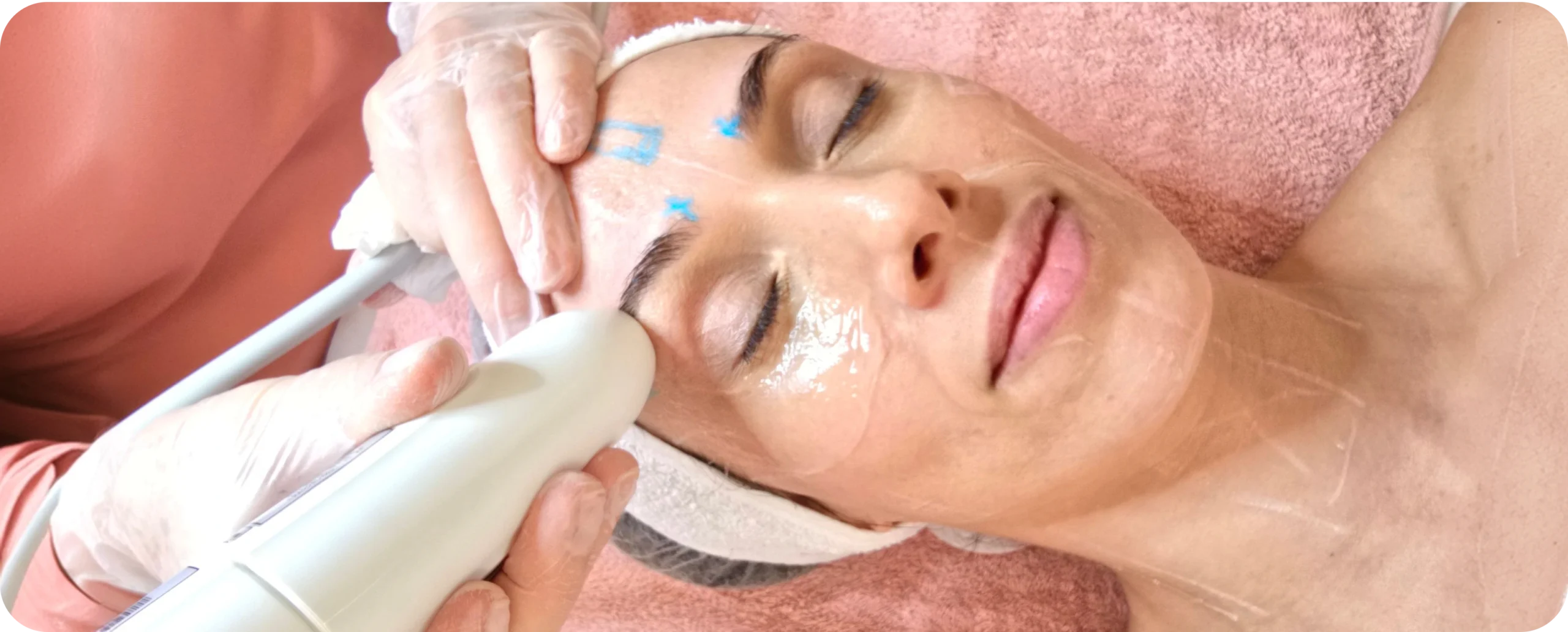 Tratamento HIFU para flacidez facial em Campinas