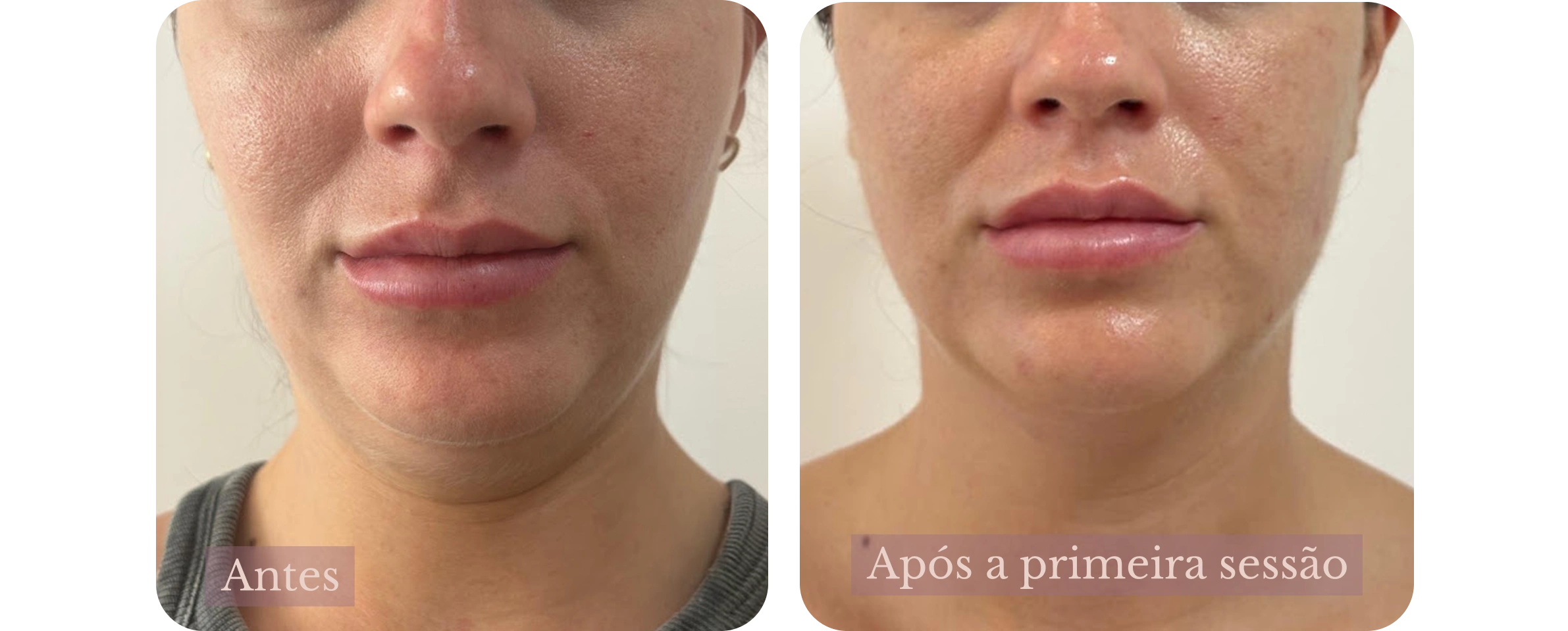Antes e depois de ultrassom microfocado no terço inferior do rosto e papada realizado por Sonia Reimberg em Campinas, SP.