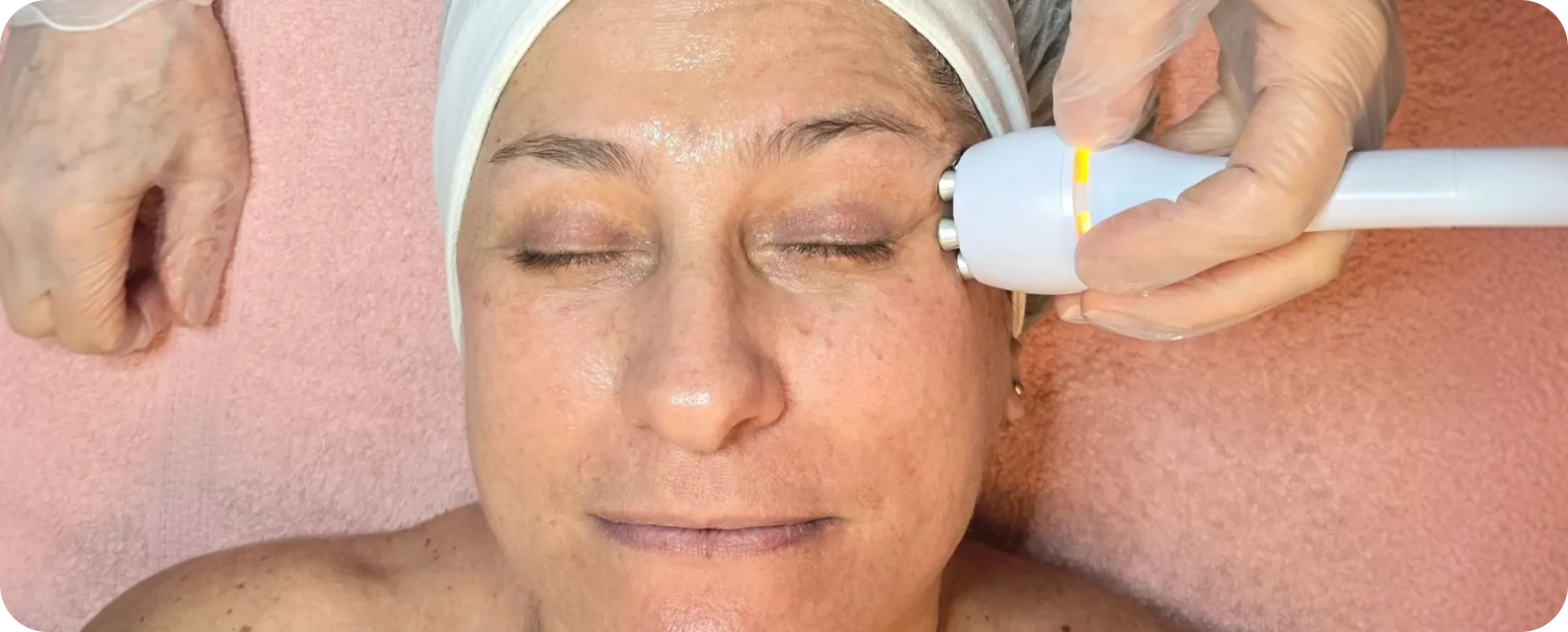 Aplicação de radiofrequência convencional na área dos olhos para tratamento de flacidez facial em Campinas-SP