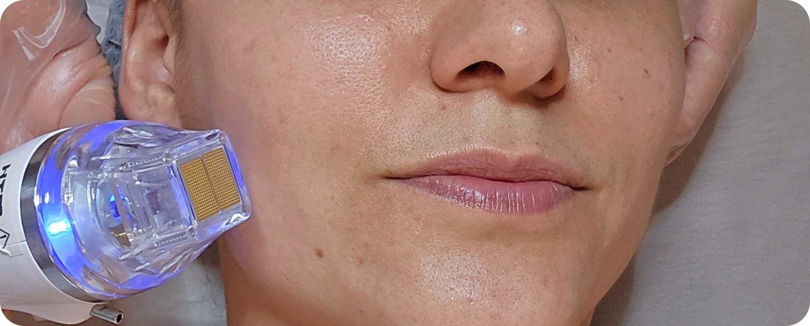 Aplicação de radiofrequência nanofracionada na bochecha para tratamento de flacidez facial em Campinas-SP