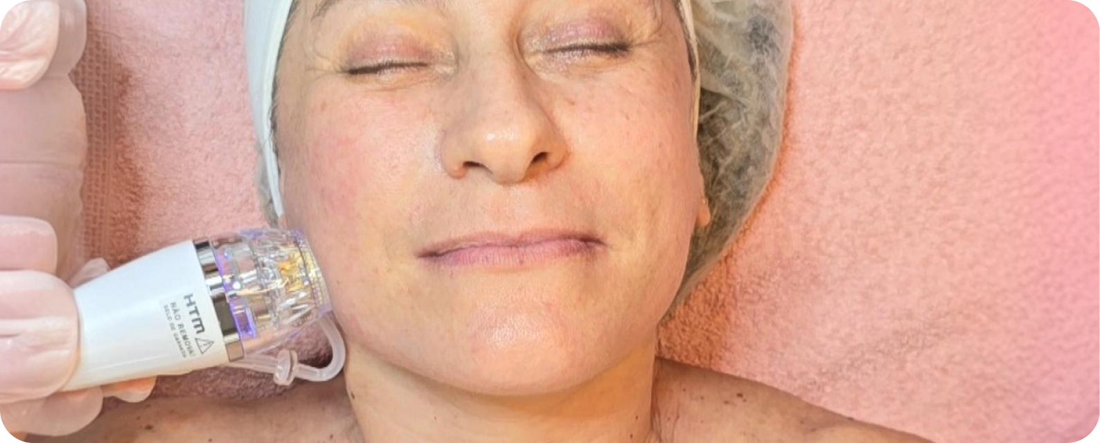 Sessão de rádiofrequência microagulhada robótica aplicada na face para tratamento de flacidez e rejuvenescimento em Campinas.