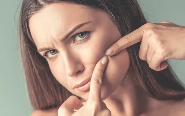 Tratamentos faciais para acne da mulher adulta em Campinas-SP